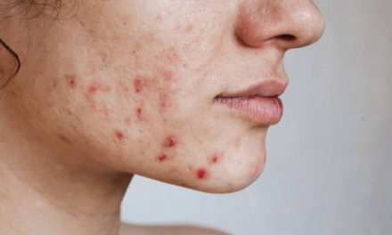 Penyebab Jerawat Usia Dewasa dan Cara Mengatasinya