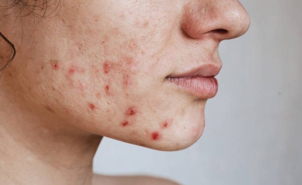 Penyebab Jerawat Usia Dewasa dan Cara Mengatasinya