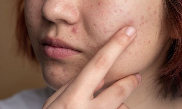 Flek Hitam Sulit Pudar? 3 Kesalahan Perawatan Ini Bisa Jadi Penyebabnya